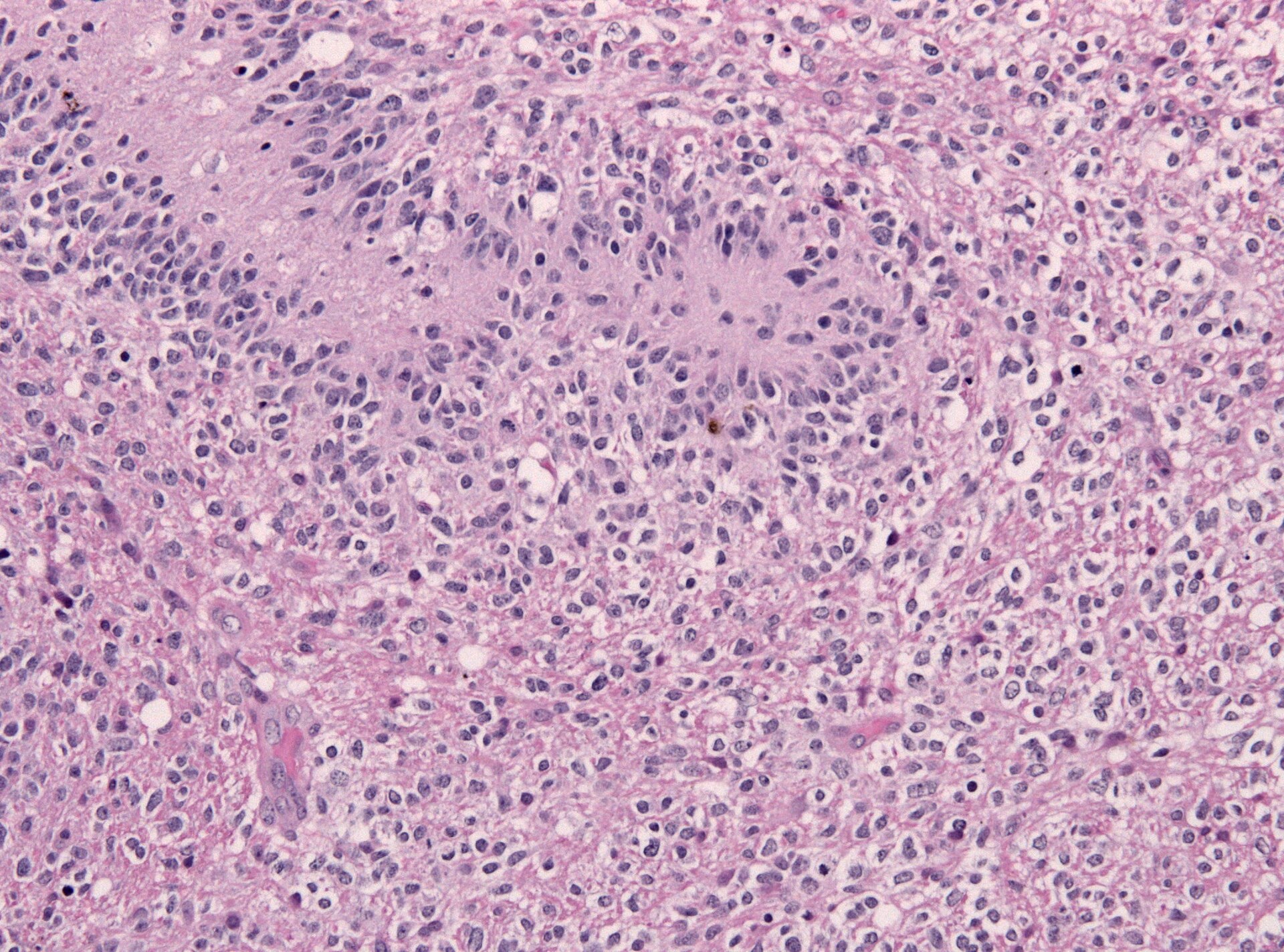 Imagem de referência de glioblastoma multiforme, descrito nos dados abertos como câncer cerebral