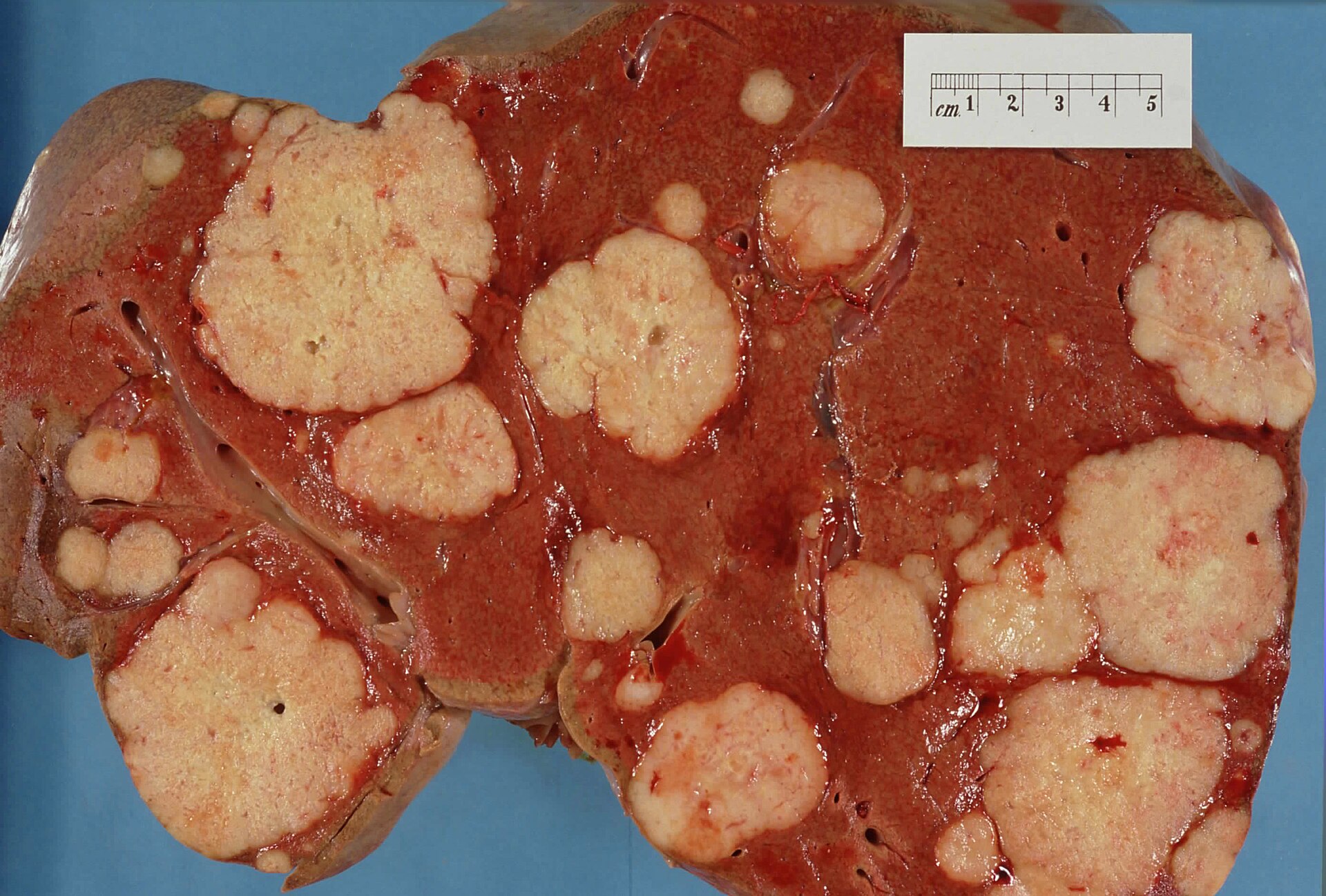 Imagem de referência de cancro do pâncreas, descrito nos dados abertos como formação de células malignas no tecido pancreático